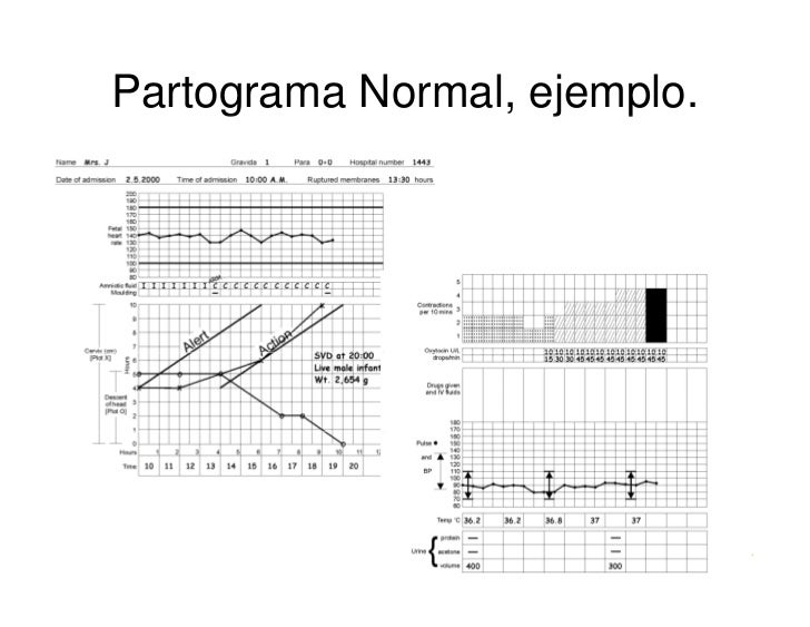 Partograma Oms Guia De Utilizacion Y Formato Hnseb