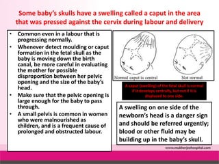 Partogram by dr alka mukherjee dr apurva mukherjee nagpur m.s. india | PPTX