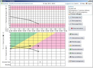 C. simplified partograph
by WHO
This version simplifies the partograph for
use at primary level.
Colour codes (green, yell...