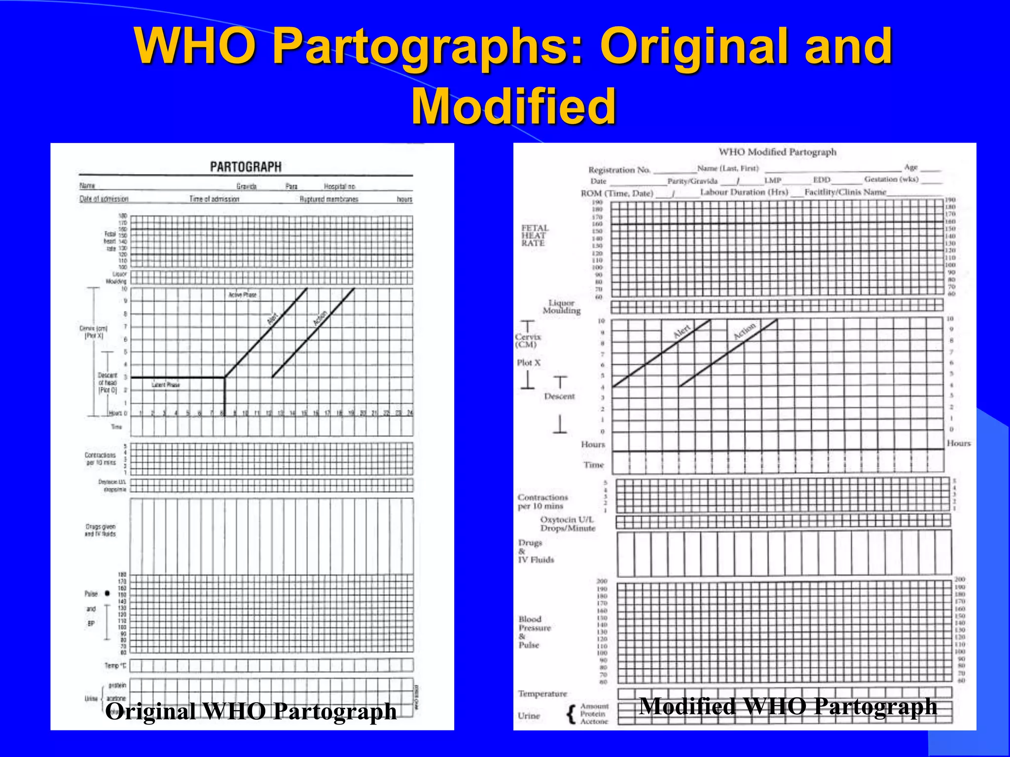 WHO Partographs: Original and
Modified
Original WHO Partograph Modified WHO PartographModified WHO Partograph
 