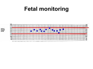 Fetal monitoring
 
