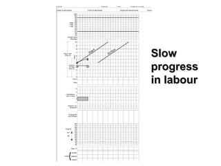 x
x
o o
SlowSlow
progressprogress
in labourin labour
 