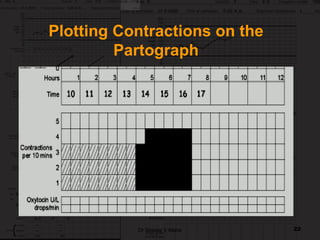 Partograph Contraction Line partograph guide through with images included | PDF