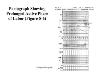Pathograph Graph Note on Partograph.ppt for the health workers | PPT