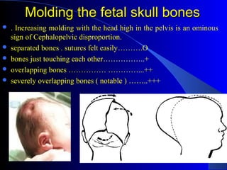 Molding the fetal skull bonesMolding the fetal skull bones
 . Increasing molding with the head high in the pelvis is an o...
