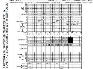Partograph Contraction Line Partograph Labour abnormalities1_2.ppt