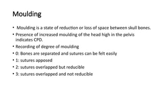 Moulding
• Moulding is a state of reduction or loss of space between skull bones.
• Presence of increased moulding of the head high in the pelvis
indicates CPD.
• Recording of degree of moulding
• 0: Bones are separated and sutures can be felt easily
• 1: sutures apposed
• 2: sutures overlapped but reducible
• 3: sutures overlapped and not reducible
 