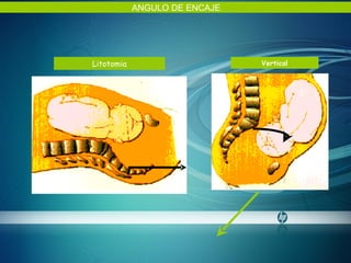 Litotomia Vertical ANGULO DE ENCAJE 