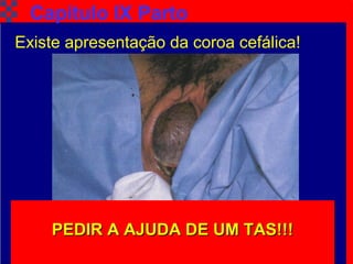 TAT Cap. 9 Parto Iminente10
Existe apresentação da coroa cefálica!
PEDIR A AJUDA DE UM TAS!!!PEDIR A AJUDA DE UM TAS!!!PEDIR A AJUDA DE UM TAS!!!PEDIR A AJUDA DE UM TAS!!!
Capítulo IX Parto
 