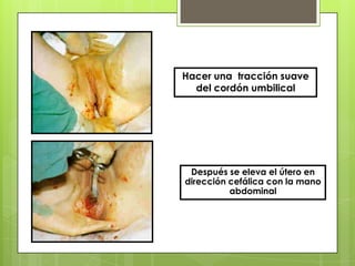 Hacer una tracción suave
del cordón umbilical
Después se eleva el útero en
dirección cefálica con la mano
abdominal
 