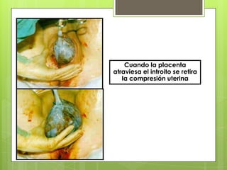 Cuando la placenta
atraviesa el introito se retira
la compresión uterina
 