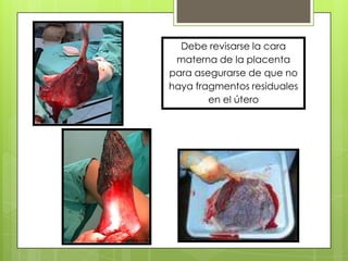 Debe revisarse la cara
materna de la placenta
para asegurarse de que no
haya fragmentos residuales
en el útero
 