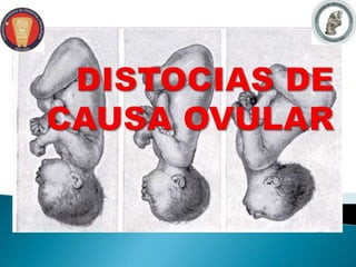 Modalidad de bregma
Causas maternas :
pelvis plana , tumores
Causas fetales :
prematuras , embarazo
gemelar
Causas ovulare...