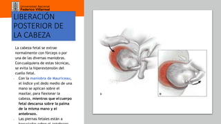 Universidad Nacional
Federico Villarreal
LIBERACIÓN
POSTERIOR DE
LA CABEZA
La cabeza fetal se extrae
normalmente con fórceps o por
una de las diversas maniobras.
Concualquiera de estas técnicas,
se evita la hiperextensión del
cuello fetal.
- Con la maniobra de Mauriceau,
el índice yel dedo medio de una
mano se aplican sobre el
maxilar, para flexionar la
cabeza, mientras que elcuerpo
fetal descansa sobre la palma
de la misma mano y el
antebrazo.
- Las piernas fetales están a
 