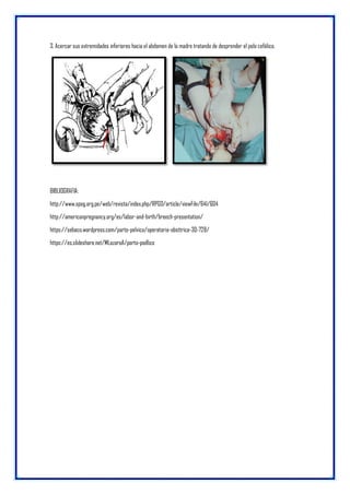 3. Acercar sus extremidades inferiores hacia el abdomen de la madre tratando de desprender el polo cefálico.
BIBLIOGRAFIA:
http://www.spog.org.pe/web/revista/index.php/RPGO/article/viewFile/641/604
http://americanpregnancy.org/es/labor-and-birth/breech-presentation/
https://sebaco.wordpress.com/parto-pelvico/operatoria-obsttrica-30-728/
https://es.slideshare.net/MLazaroA/parto-podlico
 