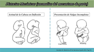 Distocias Mecánicas (anomalías del mecanismo de parto)
Actitud de la Cabeza en Deflexión Presentación de Nalgas Incompleta...