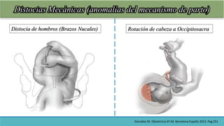 Distocias Mecánicas (anomalías del mecanismo de parto)
Distocia de hombros (Brazos Nucales) Rotación de cabeza a Occipitos...