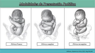 Modalidades de Presentación Podálica
Pélvica Franca Pélvica completa Pélvica incompleta
Williams, Obstetricia 24 Ed. 2015....