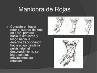 Maniobra de RojasConsiste en hacer rotar el cuerpo del feto en 180º, primero hacia la izquierda y luego hacia la derecha traccionando hacia abajo desde la pelvis fetal, el desprendimiento se logra con los movimientos de rotación