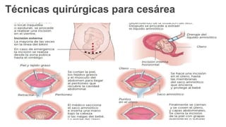 Técnicas quirúrgicas para cesárea
 