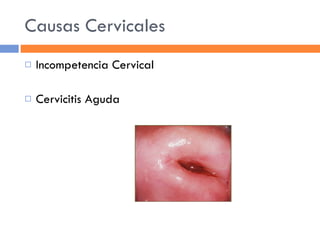 Causas Cervicales Incompetencia Cervical Cervicitis Aguda 