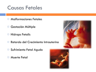 Causas Fetales Malformaciones Fetales Gestación Múltiple Hidrops Fetalis Retardo del Crecimiento Intrauterino Sufrimiento Fetal Agudo Muerte Fetal 