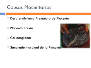 Causas Placentarias Desprendimiento Prematuro de Placenta Placenta Previa Corioangioma Sangrado marginal de la Placenta 