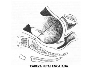 CABEZA FETAL ENCAJADA
 