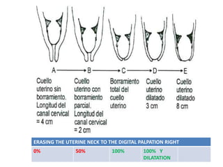 ERASING THE UTERINE NECK TO THE DIGITAL PALPATION RIGHT
0% 50% 100% 100% Y
DILATATION
 
