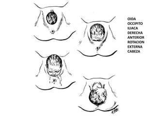 OIDA
OCCIPITO
ILIACA
DERECHA
ANTERIOR
ROTACION
EXTERNA
CABEZA
 