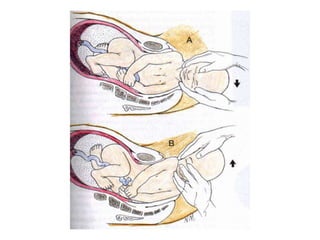 Parto  presentaciones fetales 9 aaa