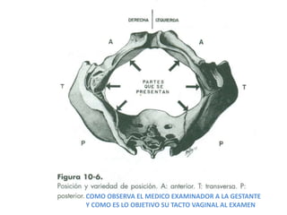 COMO OBSERVA EL MEDICO EXAMINADOR A LA GESTANTE
Y COMO ES LO OBJETIVO SU TACTO VAGINAL AL EXAMEN
 