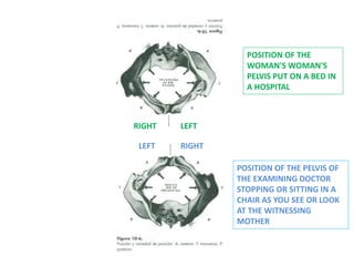 RIGHTLEFT
LEFTRIGHT
POSITION OF THE PELVIS OF
THE EXAMINING DOCTOR
STOPPING OR SITTING IN A
CHAIR AS YOU SEE OR LOOK
AT THE WITNESSING
MOTHER
POSITION OF THE
WOMAN'S WOMAN'S
PELVIS PUT ON A BED IN
A HOSPITAL
 