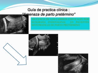 SECUENCIA DE LOS CAMBIOS CERVICALES POR
ECOGRAFIA ENDOVAGINAL
EN PACIENTES
SINTOMATICAS DE PARTO PRETÉRMINO

 