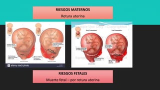 RIESGOS FETALES
Muerte fetal – por rotura uterina
RIESGOS MATERNOS
Rotura uterina
 