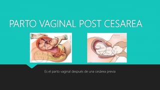 PARTO VAGINAL POST CESAREA
Es el parto vaginal después de una cesárea previa
 