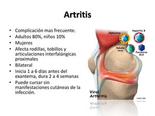ArtritisComplicación mas frecuente.Adultos 80%, niños 10%Mujeres Afecta rodillas, tobillos y articulaciones interfalángicas proximalesBilateralInicia 1 a 6 días antes del exantema, dura 2 a 4 semanasPuede cursar sin manifestaciones cutáneas de la infección.