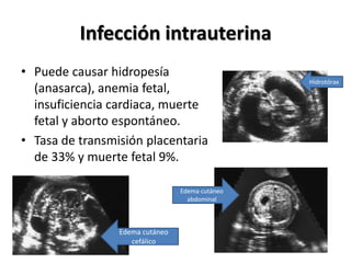 Infección intrauterina Puede causar hidropesía (anasarca), anemia fetal, insuficiencia cardiaca, muerte fetal y aborto espontáneo.Tasa de transmisión placentaria de 33% y muerte fetal 9%.HidrotóraxEdema cutáneo abdominalEdema cutáneo cefálico 