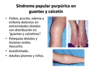 Síndrome papularpurpúricoenguantes y calcetínFiebre, prurito, edema y eritema doloroso en extremidades distales con distribución en “guantes y calcetines”.Petequias distales y lesiones orales. Vasculitis.Autolimitado.Adultos jóvenes y niños.