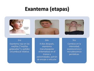 Exantema (etapas)