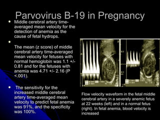 Parvovirus B-19 in Pregnancy Middle cerebral artery time-averaged mean velocity for the detection of anemia as the cause of fetal hydrops. The mean (z score) of middle cerebral artery time-averaged mean velocity for fetuses with normal hemoglobin was 1.1 +/- 0.81 and for the fetuses with anemia was 4.71 +/- 2.16 (P <.001). The sensitivity for the increased middle cerebral artery time-averaged mean velocity to predict fetal anemia was 91%, and the specificity was 100%.  Flow velocity waveform in the fetal middle cerebral artery in a severely anemic fetus at 22 weeks (left) and in a normal fetus (right). In fetal anemia, blood velocity is increased  