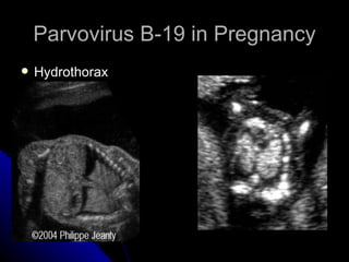 Parvovirus B-19 in Pregnancy Hydrothorax 
