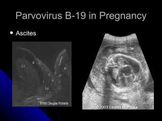 Parvovirus B-19 in Pregnancy Ascites 
