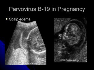 Parvovirus B-19 in Pregnancy Scalp edema 