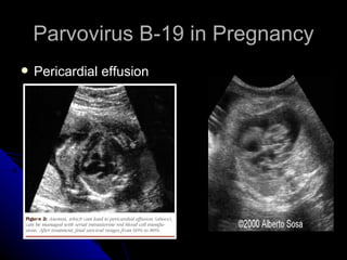 Parvovirus B-19 in Pregnancy Pericardial effusion 