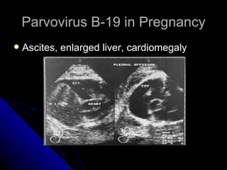 Parvovirus B-19 in Pregnancy Ascites, enlarged liver, cardiomegaly 