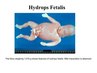 Hydrops Fetalis
The fetus weighing 1,010 g shows features of hydrops fetalis. Mild maceration is observed