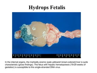 Hydrops Fetalis
In the internal organs, the markedly anemic (pale yellowish brown-colored) liver is quite
characteristic (gross findings). The fetus with hepatic hematopoiesis (19-29 weeks of
gestation) is susceptible to this single-stranded DNA virus.