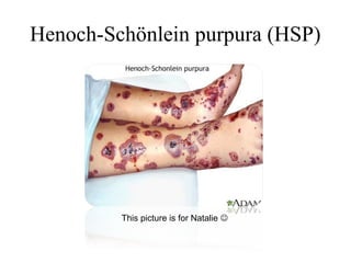 Henoch-Schönlein purpura (HSP)
This picture is for Natalie 