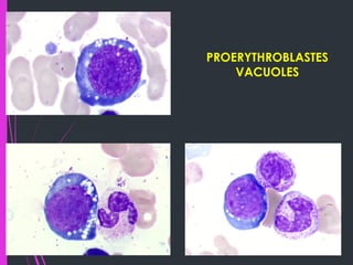 B19 Inside Inside the Cell: Parvovirus B19’s Cytological Signatures | PDF